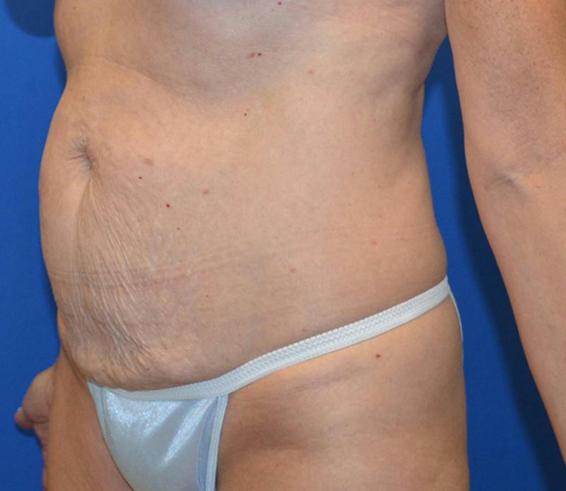 Tummy Tuck Before & After Gallery - Patient 586927 - Image 5