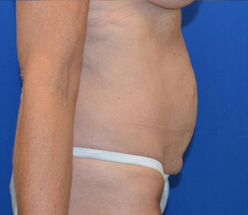 Tummy Tuck Before & After Gallery - Patient 586927 - Image 7