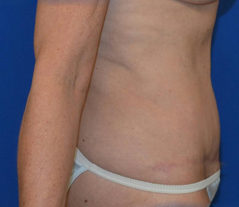 Tummy Tuck Before & After Gallery - Patient 586927 - Image 8