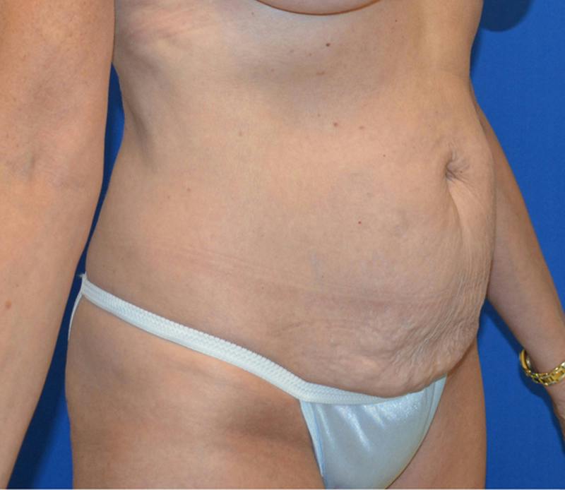 Tummy Tuck Before & After Gallery - Patient 586927 - Image 9