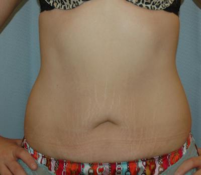 Tummy Tuck Before & After Gallery - Patient 167425 - Image 1