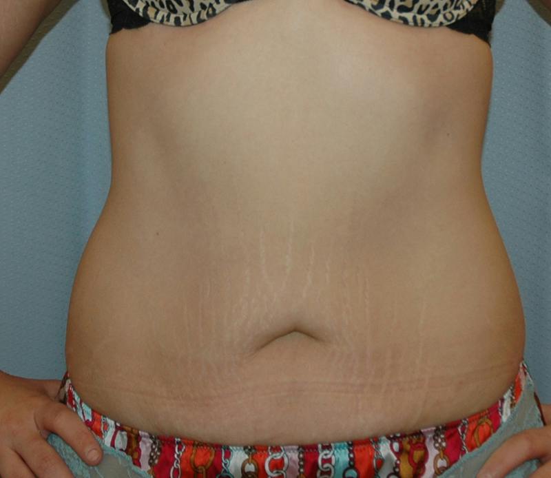 Tummy Tuck Before & After Gallery - Patient 167425 - Image 1