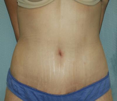 Tummy Tuck Before & After Gallery - Patient 167425 - Image 2