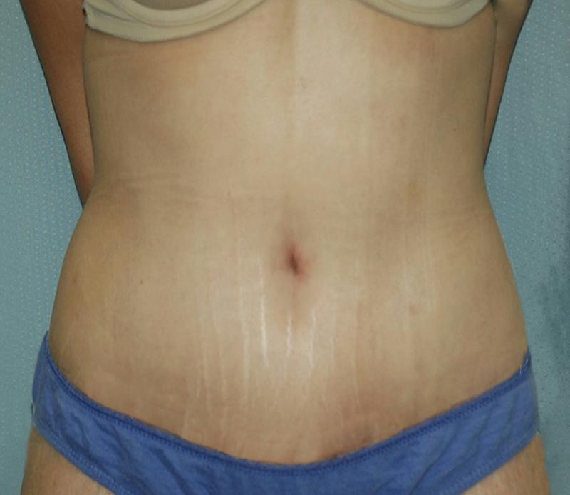 Tummy Tuck Before & After Gallery - Patient 167425 - Image 2