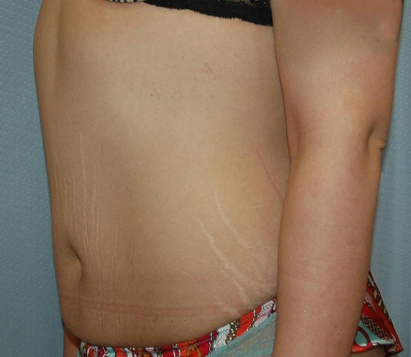 Tummy Tuck Before & After Gallery - Patient 167425 - Image 3