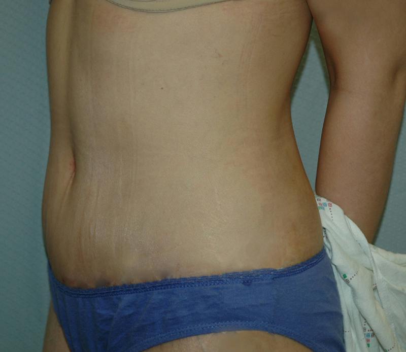 Tummy Tuck Before & After Gallery - Patient 167425 - Image 4