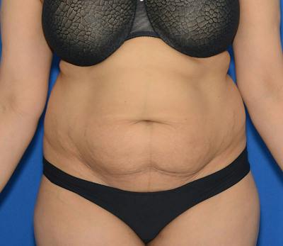 Tummy Tuck Before & After Gallery - Patient 348180 - Image 1