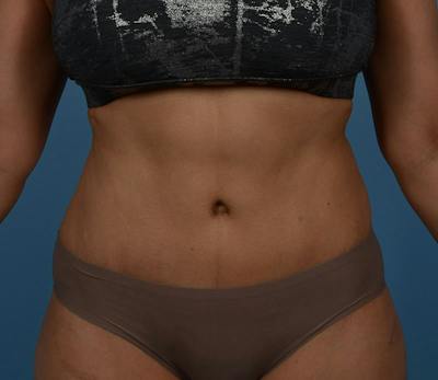 Tummy Tuck Before & After Gallery - Patient 348180 - Image 2