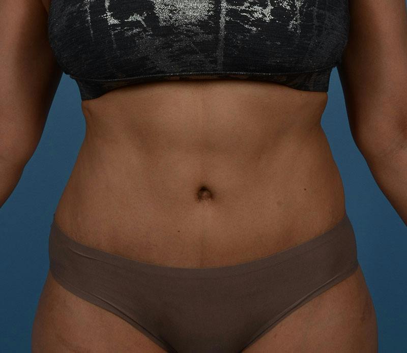 Tummy Tuck Before & After Gallery - Patient 348180 - Image 2