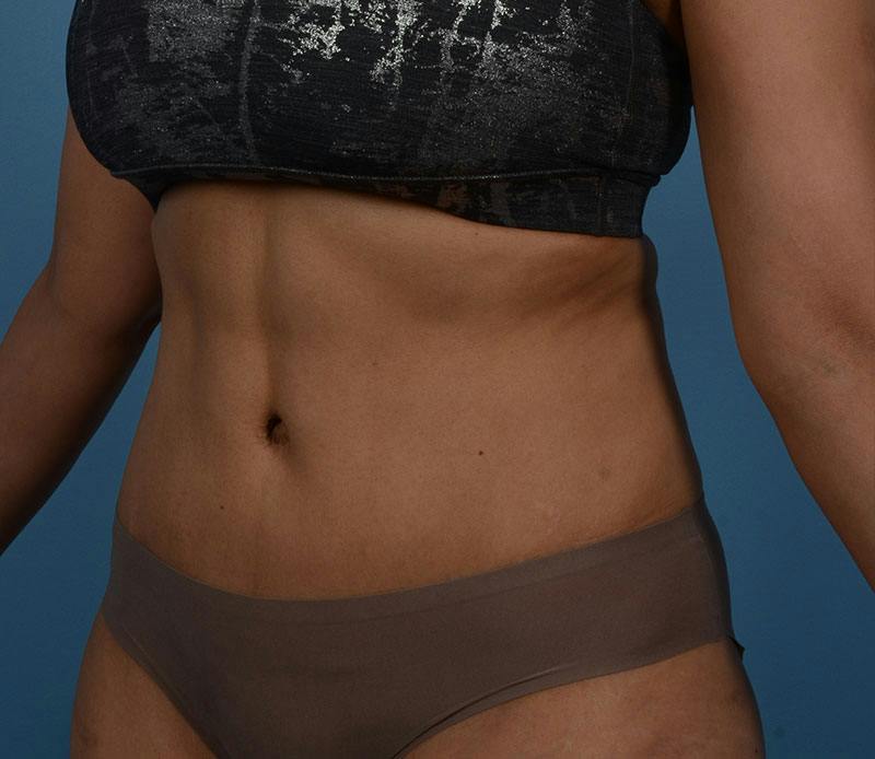 Tummy Tuck Before & After Gallery - Patient 348180 - Image 4