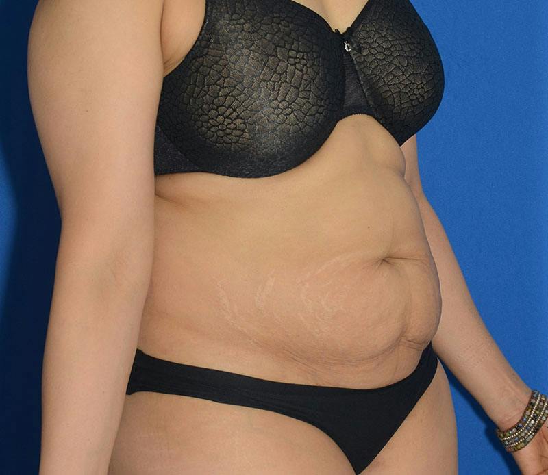 Tummy Tuck Before & After Gallery - Patient 348180 - Image 7