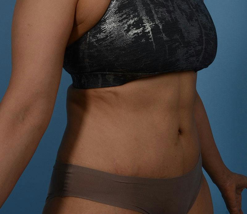 Tummy Tuck Before & After Gallery - Patient 348180 - Image 8