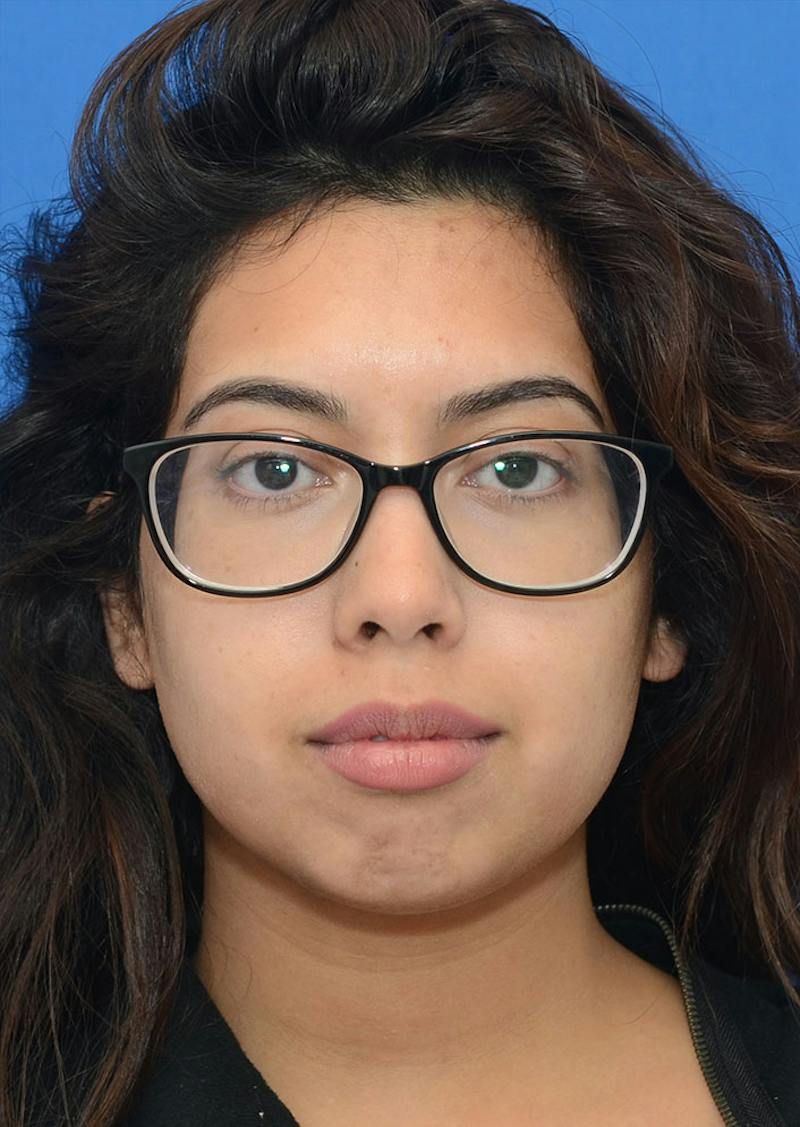 Non Surgical Chin Augmentation Before & After Gallery - Patient 130319 - Image 3