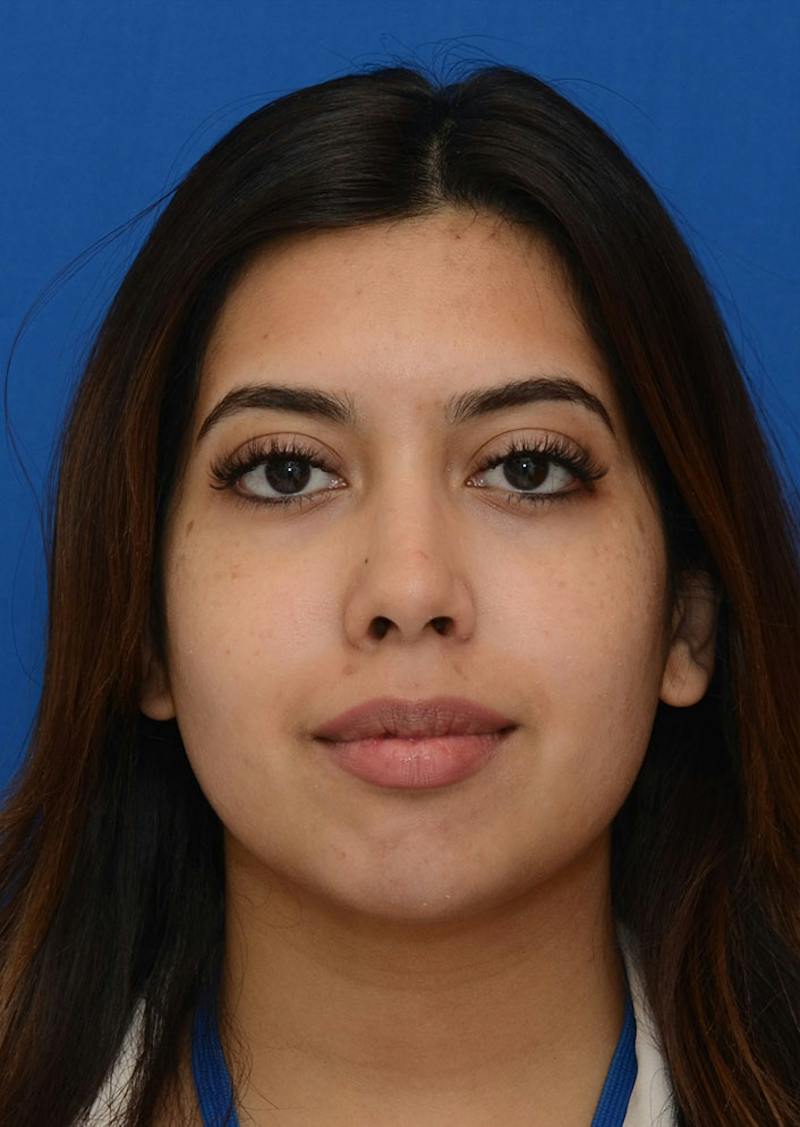 Non Surgical Chin Augmentation Before & After Gallery - Patient 130319 - Image 4