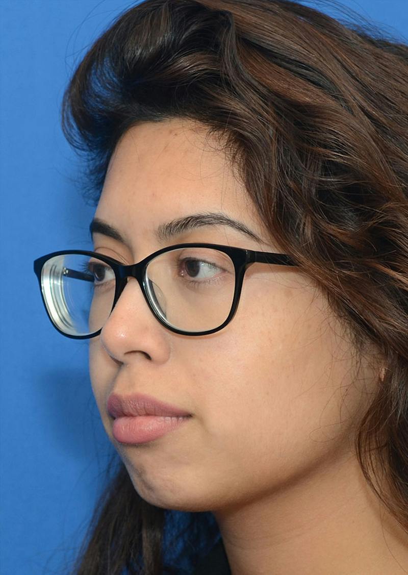 Non Surgical Chin Augmentation Before & After Gallery - Patient 130319 - Image 5