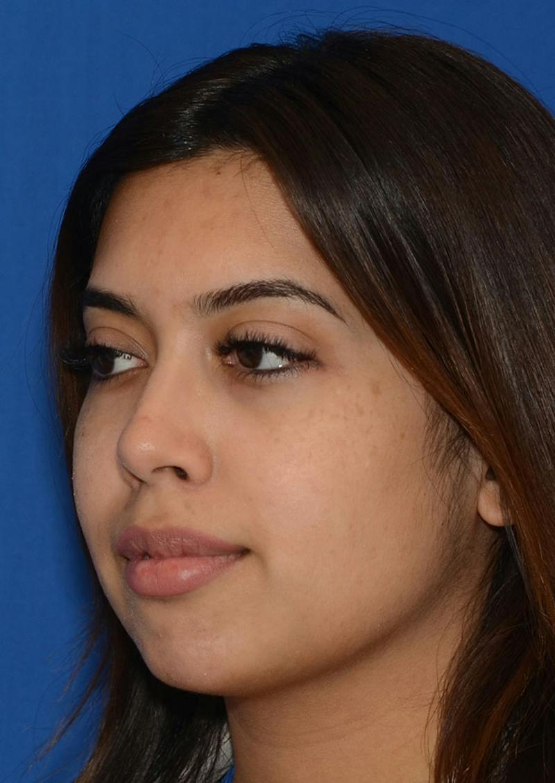 Non Surgical Chin Augmentation Before & After Gallery - Patient 130319 - Image 6