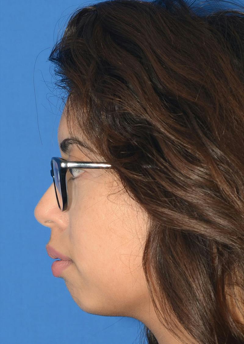 Non Surgical Chin Augmentation Before & After Gallery - Patient 130319 - Image 7