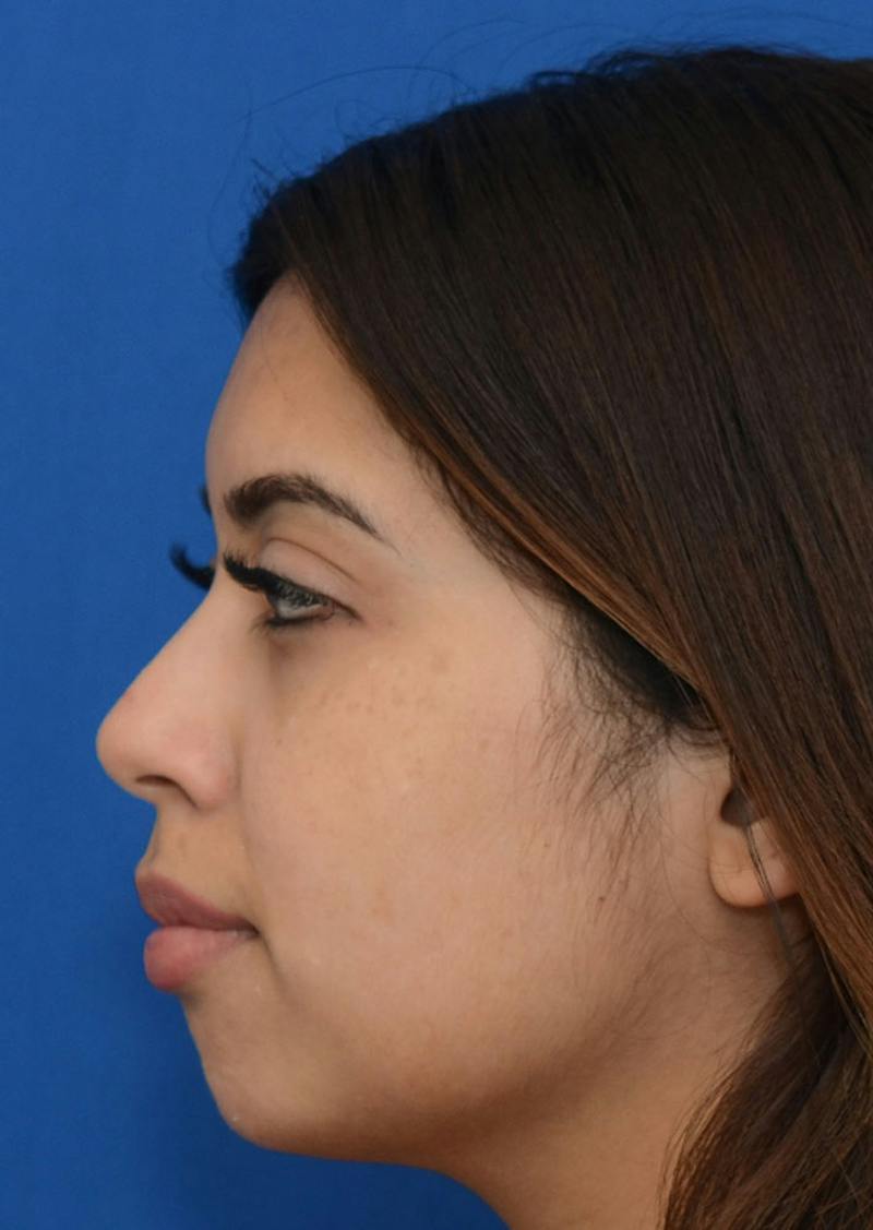 Non Surgical Chin Augmentation Before & After Gallery - Patient 130319 - Image 8