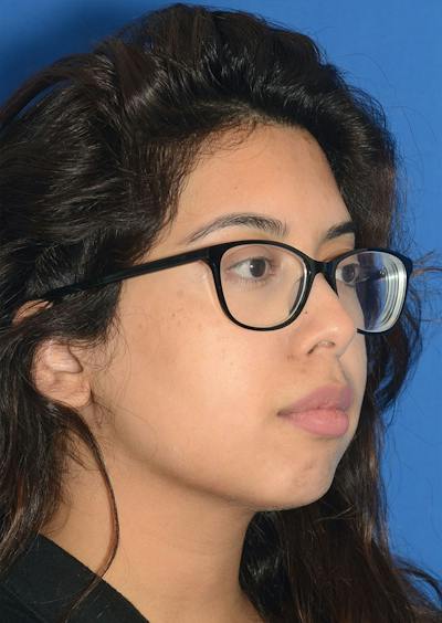 Non Surgical Chin Augmentation Before & After Gallery - Patient 130319 - Image 1