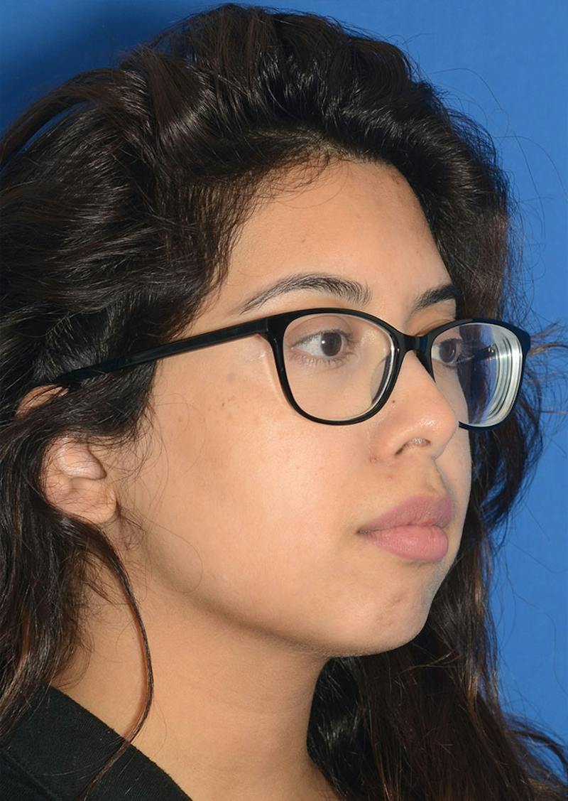 Non Surgical Chin Augmentation Before & After Gallery - Patient 130319 - Image 1