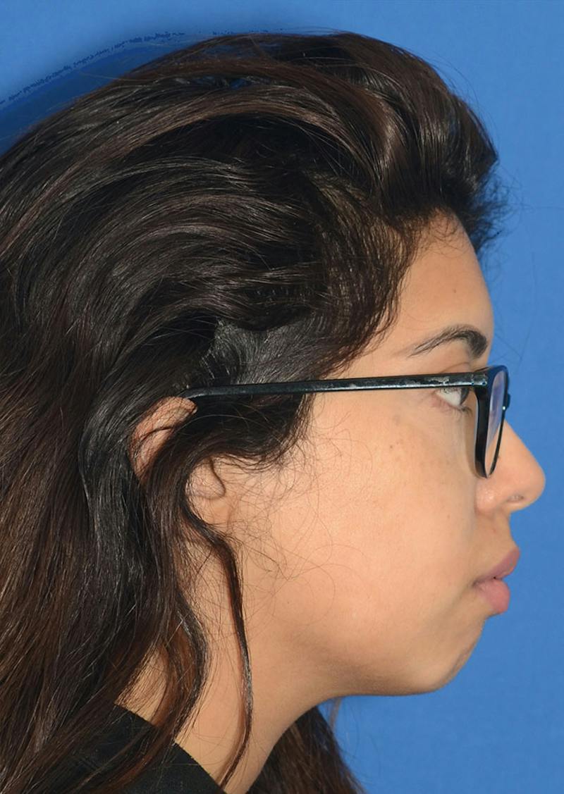 Non Surgical Chin Augmentation Before & After Gallery - Patient 130319 - Image 9