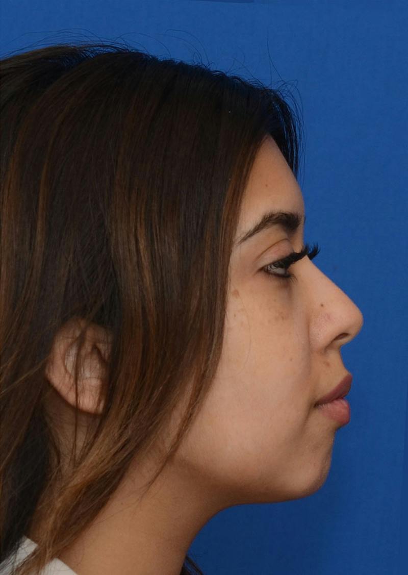 Non Surgical Chin Augmentation Before & After Gallery - Patient 130319 - Image 10