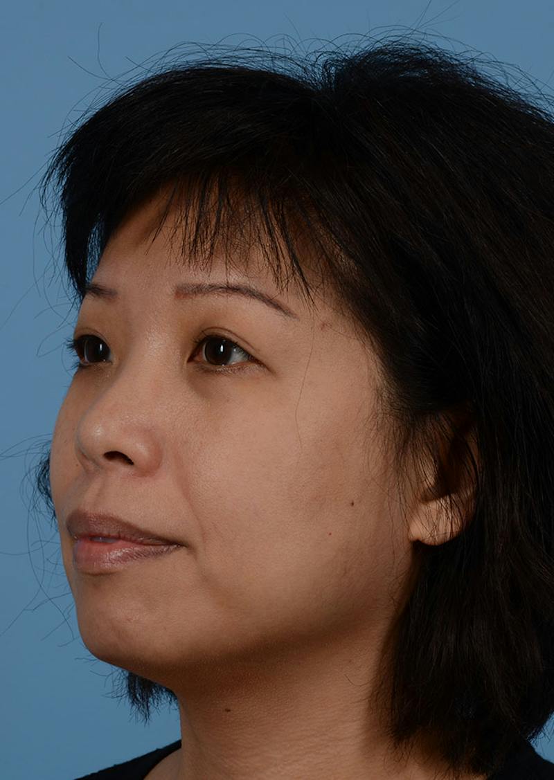 Non Surgical Chin Augmentation Before & After Gallery - Patient 635170 - Image 5