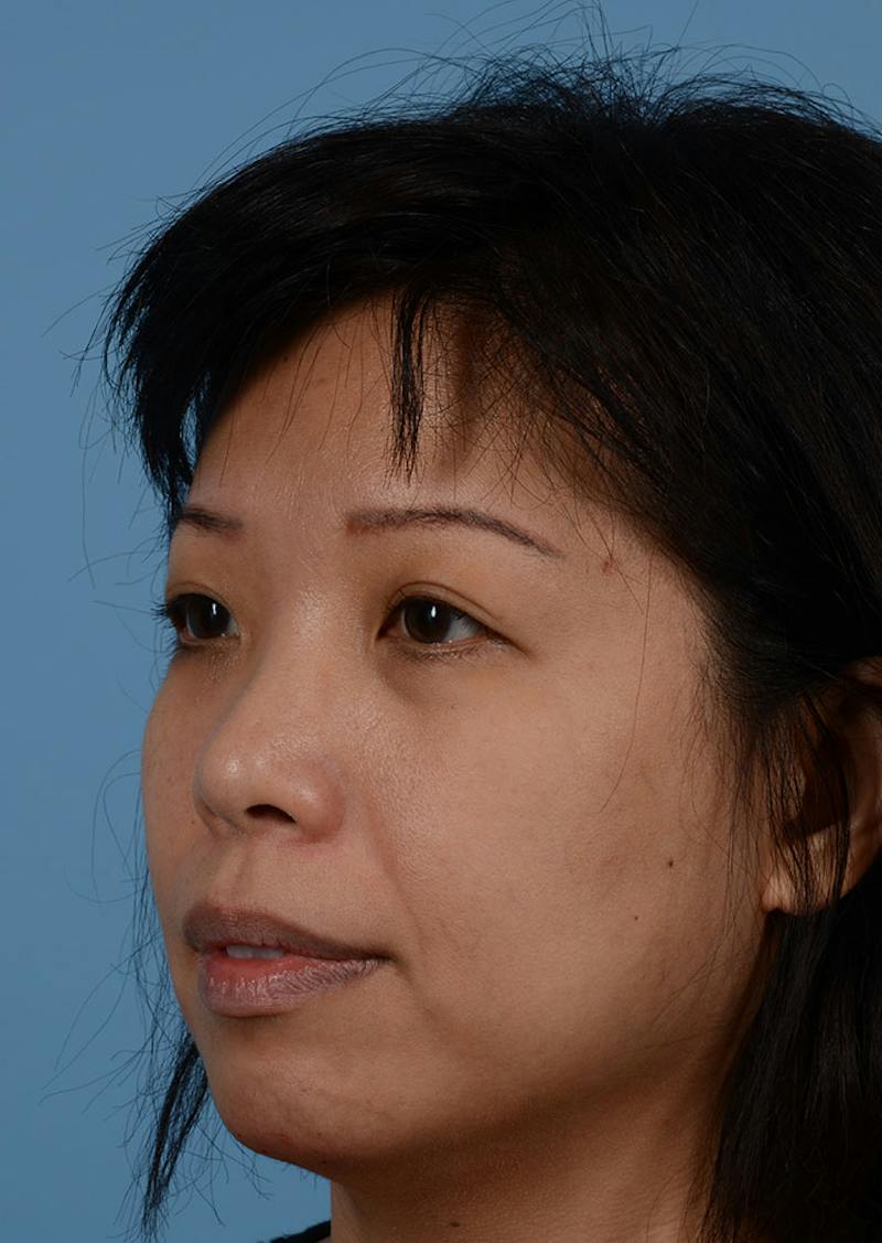 Non Surgical Chin Augmentation Before & After Gallery - Patient 635170 - Image 6