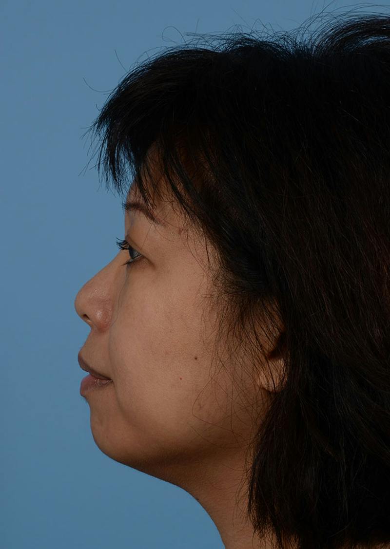 Non Surgical Chin Augmentation Before & After Gallery - Patient 635170 - Image 7