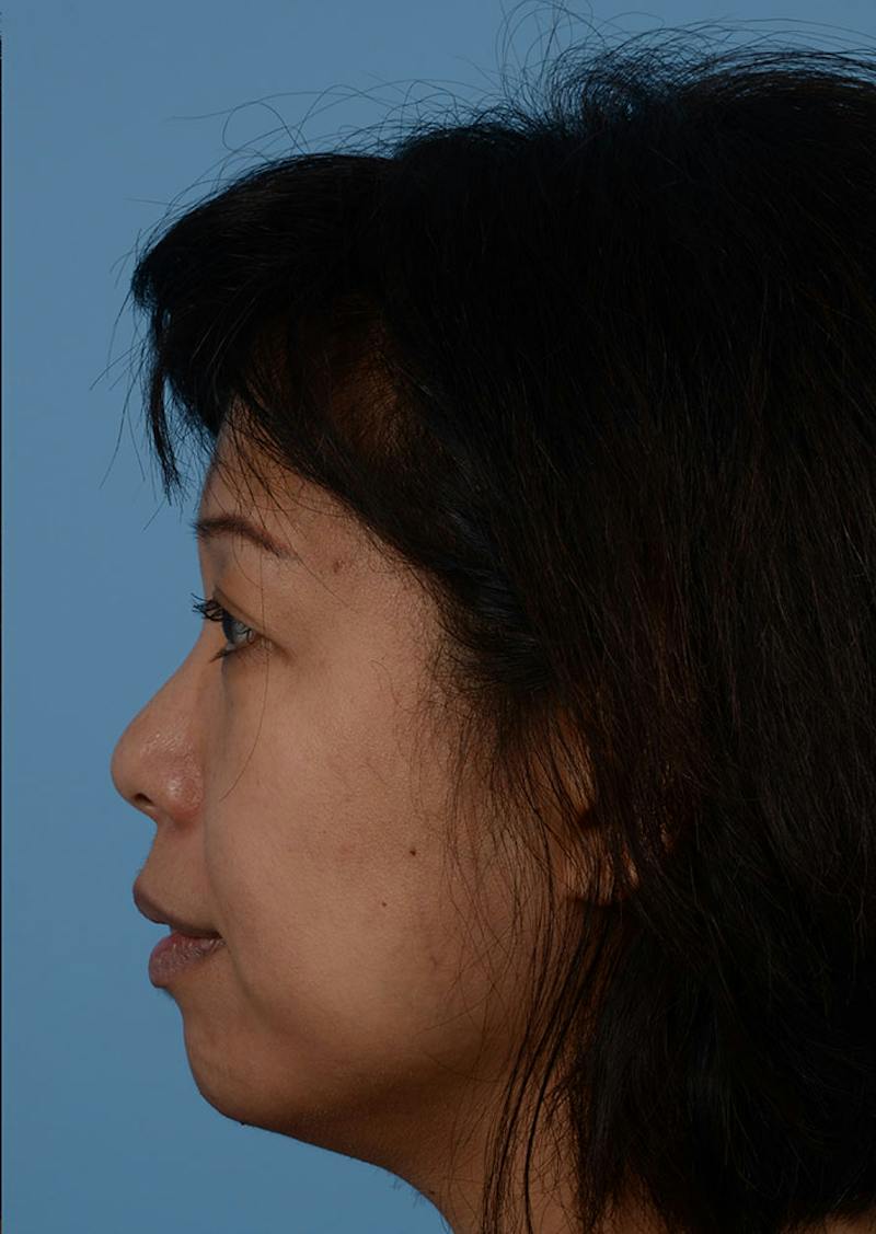 Non Surgical Chin Augmentation Before & After Gallery - Patient 635170 - Image 8