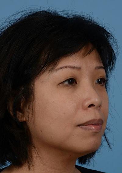Non Surgical Chin Augmentation Before & After Gallery - Patient 635170 - Image 1