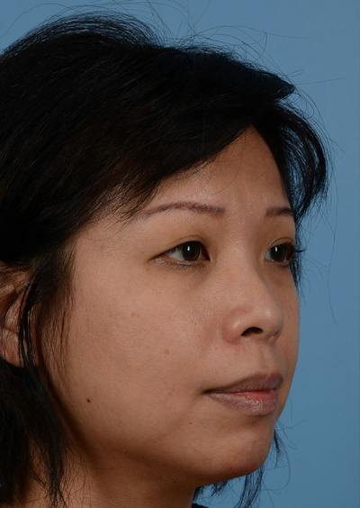 Non Surgical Chin Augmentation Before & After Gallery - Patient 635170 - Image 2