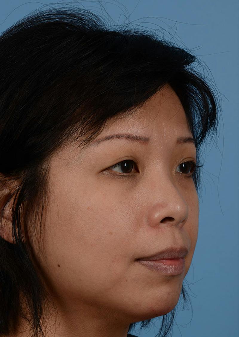 Non Surgical Chin Augmentation Before & After Gallery - Patient 635170 - Image 2