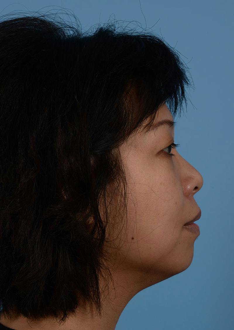 Non Surgical Chin Augmentation Before & After Gallery - Patient 635170 - Image 3