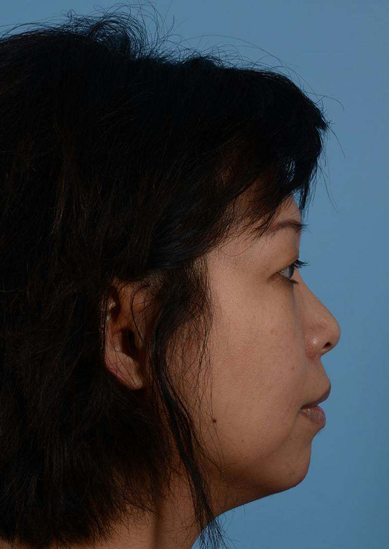 Non Surgical Chin Augmentation Before & After Gallery - Patient 635170 - Image 4