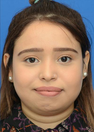 Non Surgical Rhinoplasty Before & After Gallery - Patient 287956 - Image 1