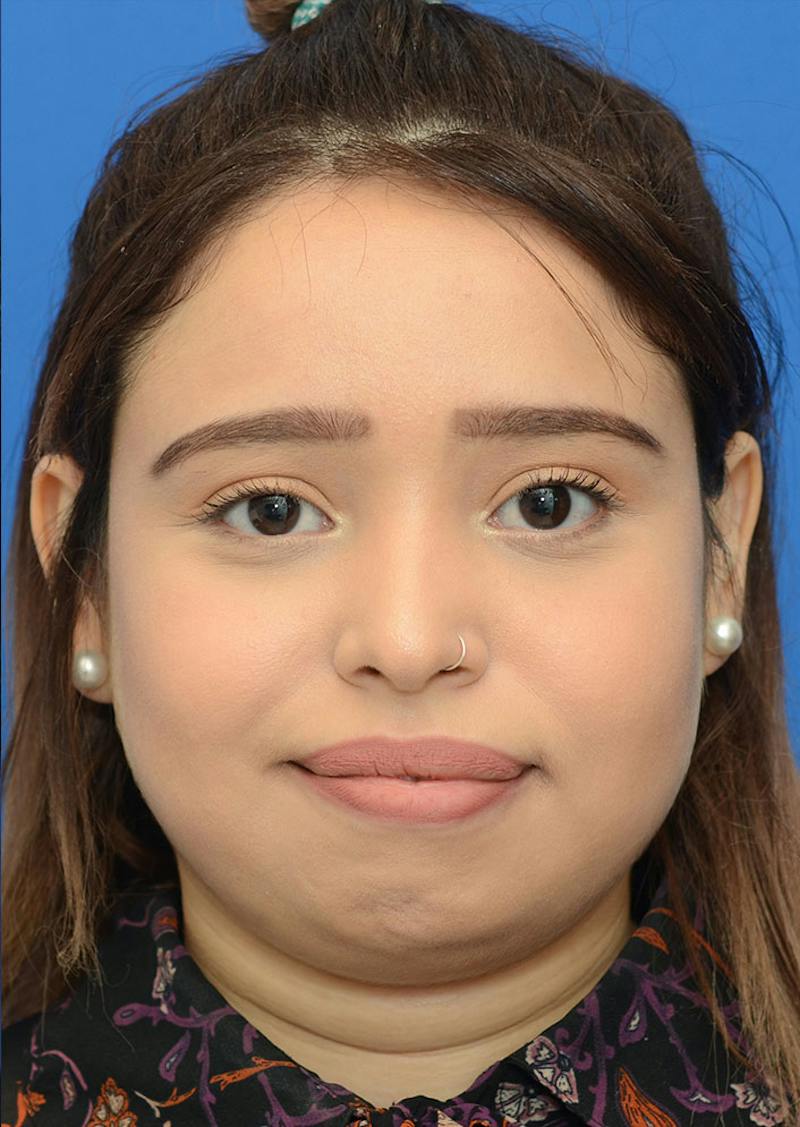Non Surgical Rhinoplasty Before & After Gallery - Patient 287956 - Image 1