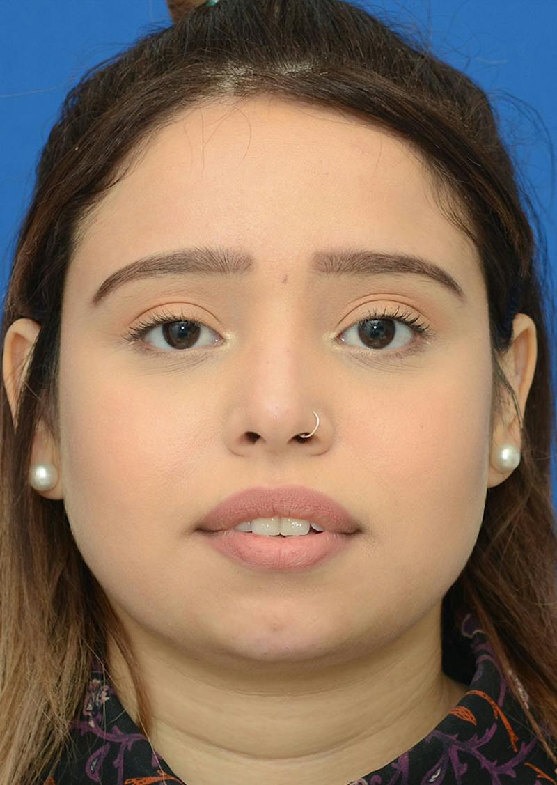 Non Surgical Rhinoplasty Before & After Gallery - Patient 287956 - Image 2