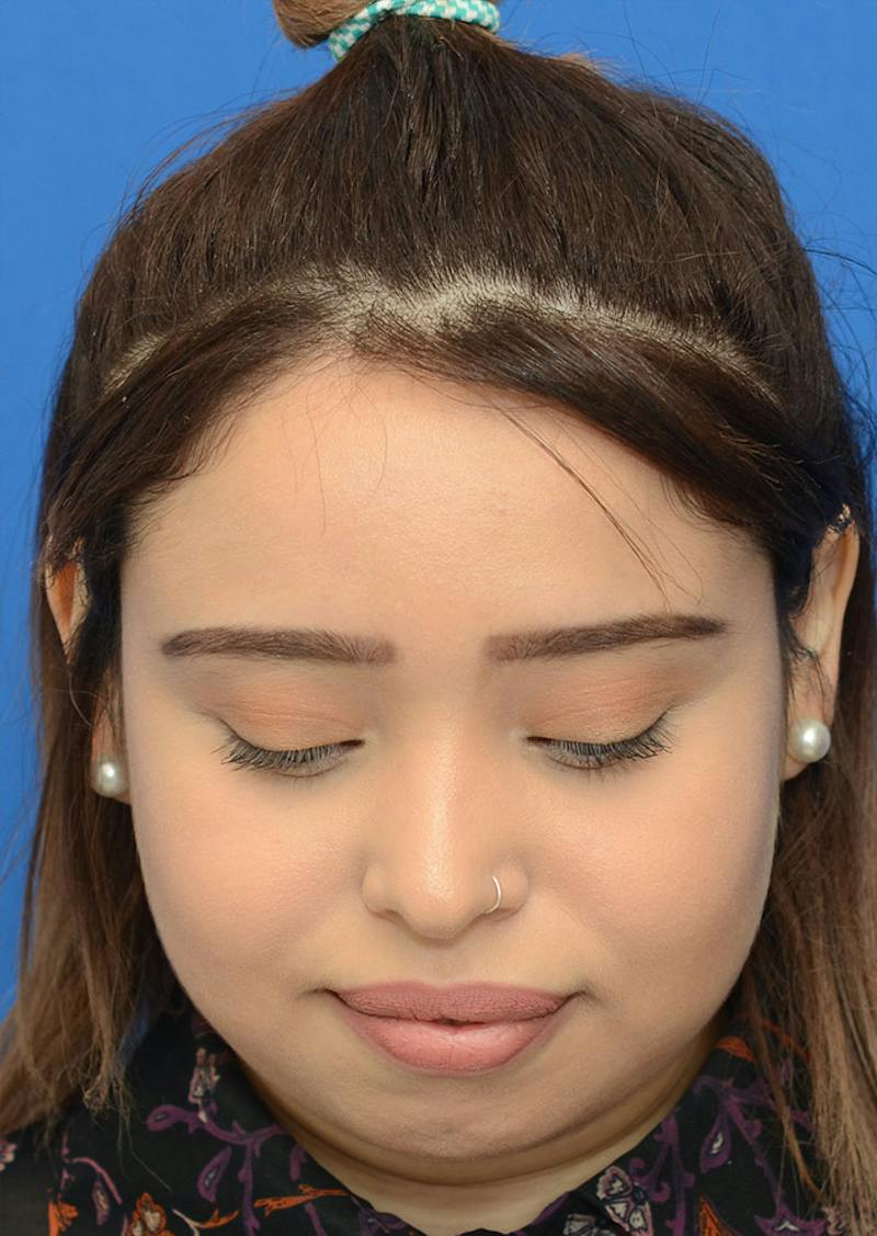 Non Surgical Rhinoplasty Before & After Gallery - Patient 287956 - Image 3