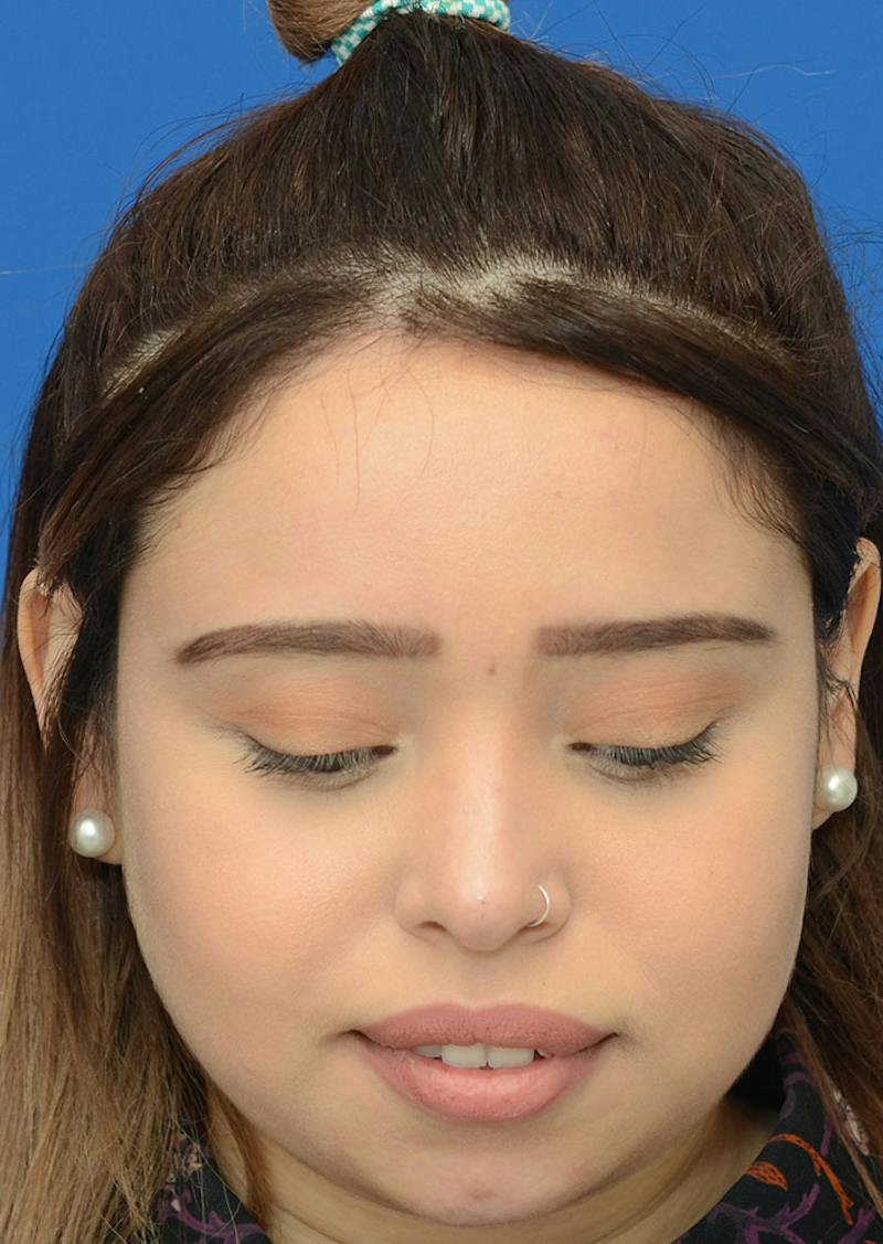 Non Surgical Rhinoplasty Before & After Gallery - Patient 287956 - Image 4