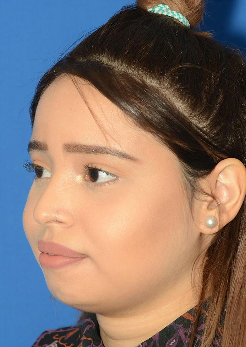 Non Surgical Rhinoplasty Before & After Gallery - Patient 287956 - Image 5