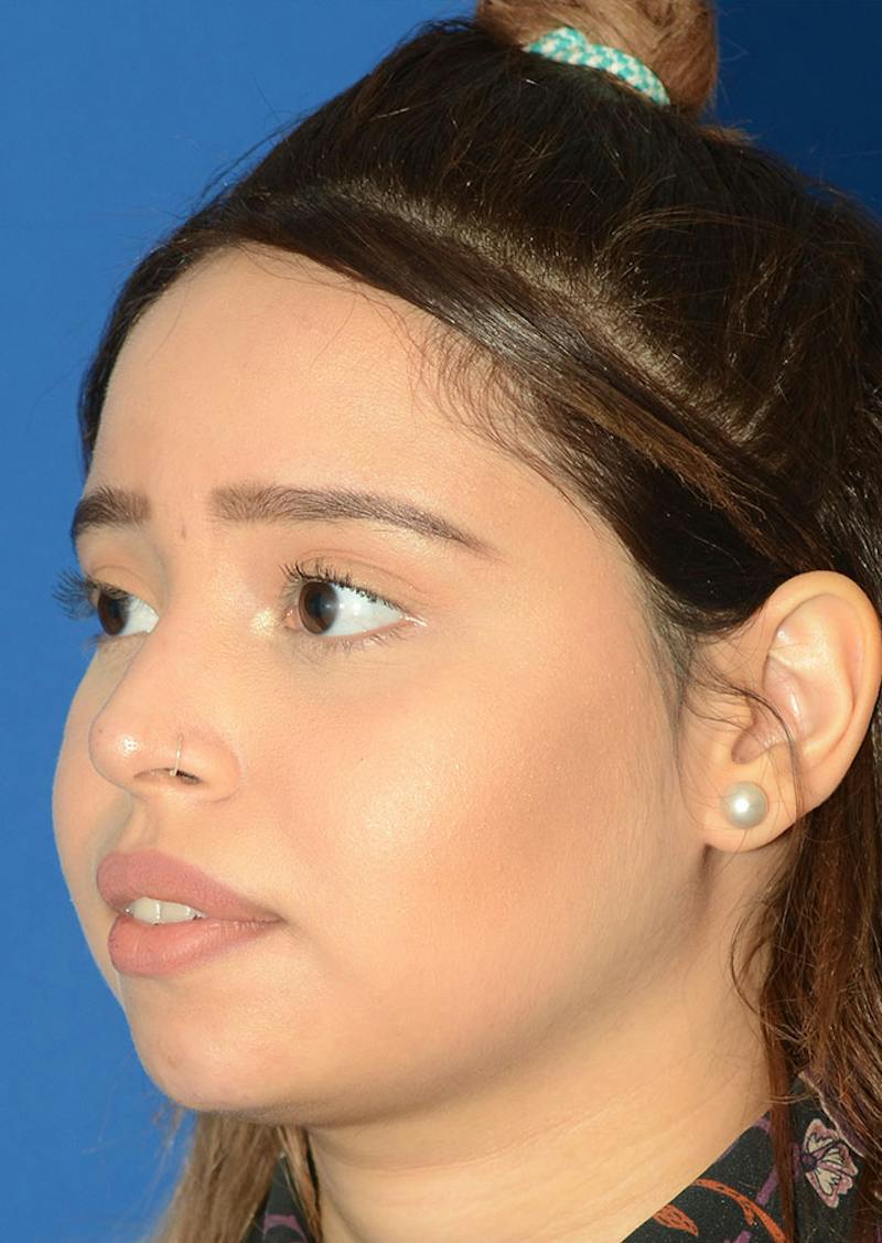 Non Surgical Rhinoplasty Before & After Gallery - Patient 287956 - Image 6