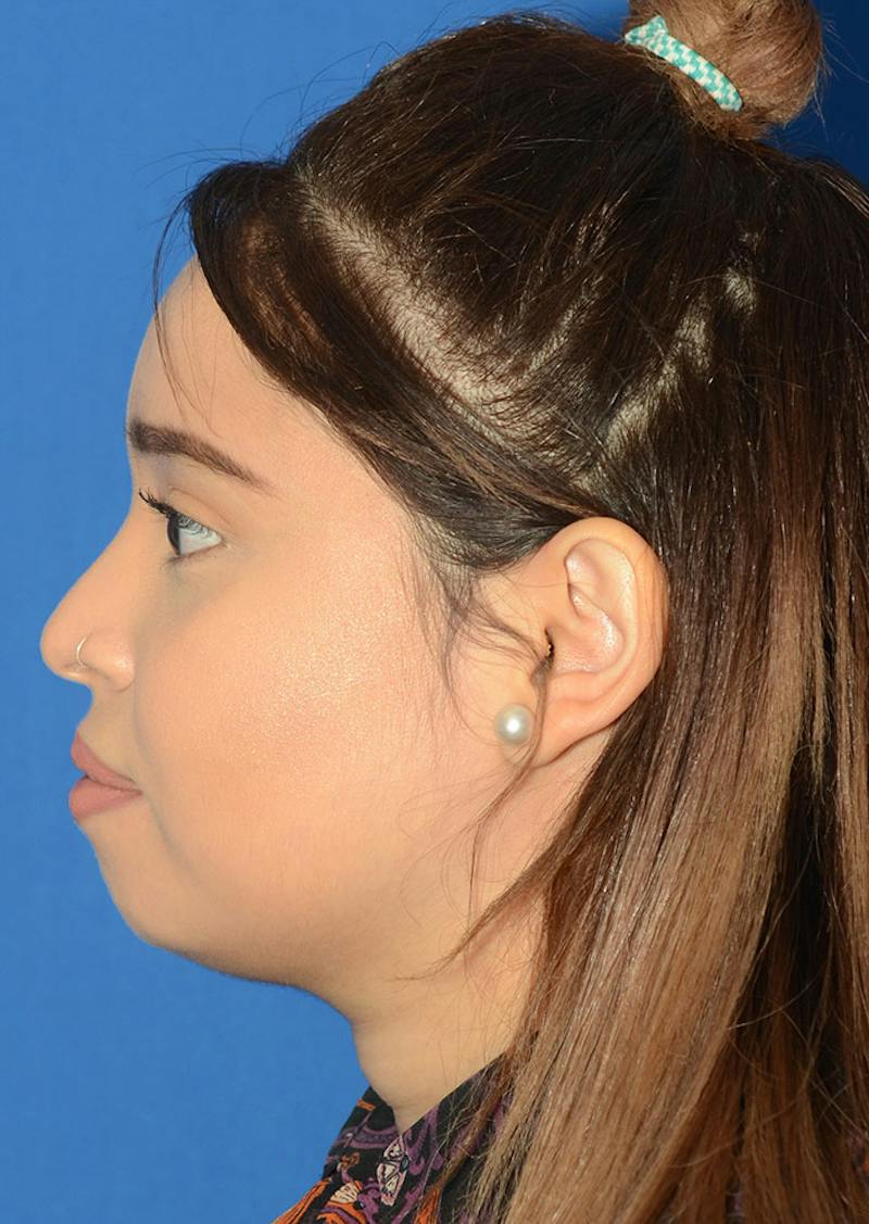 Non Surgical Rhinoplasty Before & After Gallery - Patient 287956 - Image 7