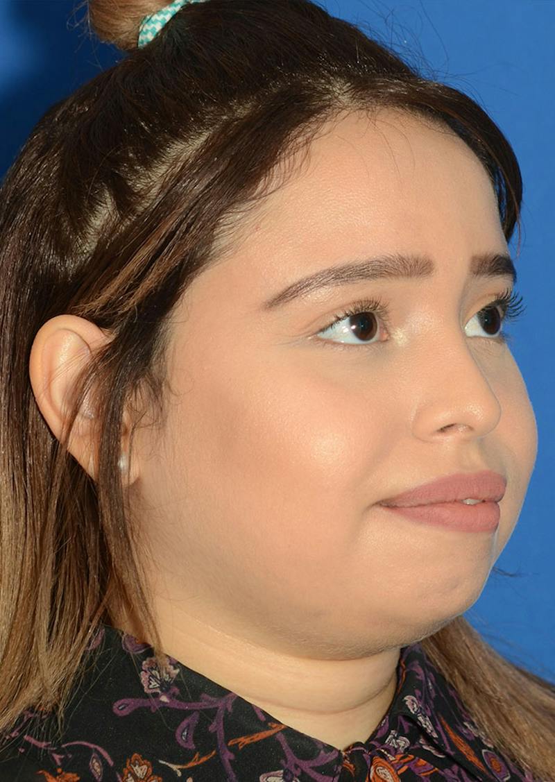 Non Surgical Rhinoplasty Before & After Gallery - Patient 287956 - Image 9
