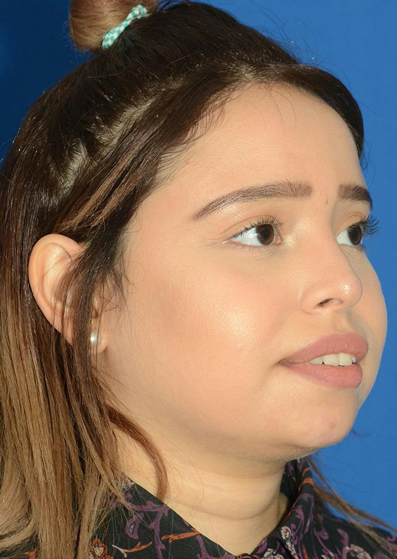 Non Surgical Rhinoplasty Before & After Gallery - Patient 287956 - Image 10