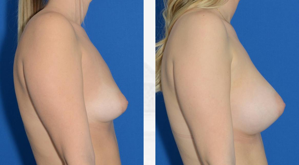 Breast Augmentation Before & After
