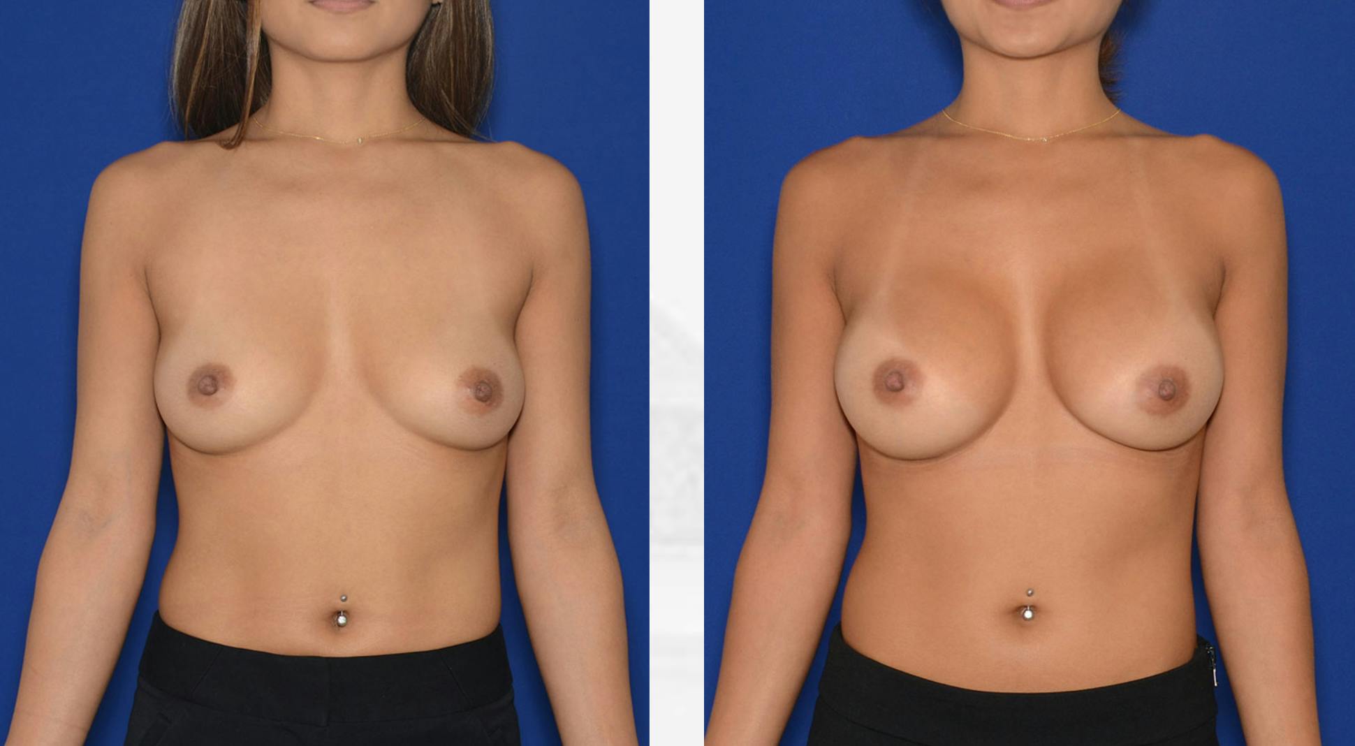 Breast Augmentation Before & After