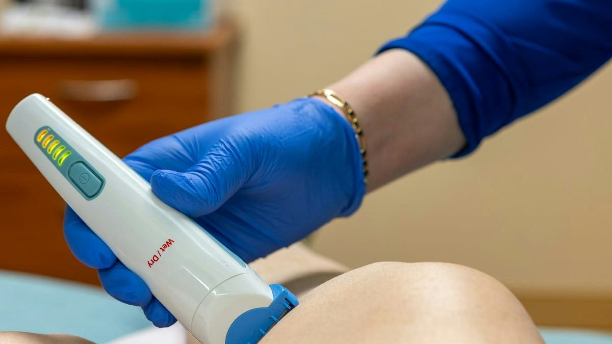 Professional laser hair removal treatment in progress at Geneva Med, showing effective hair reduction results for patien