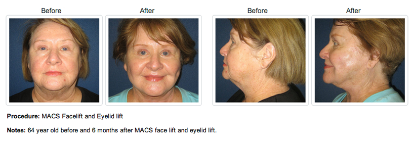 Before and after photo of an older woman who got a facelift from Dr. Alizadeh.