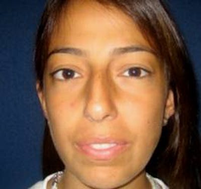 Rhinoplasty Before & After Gallery - Patient 4447364 - Image 1